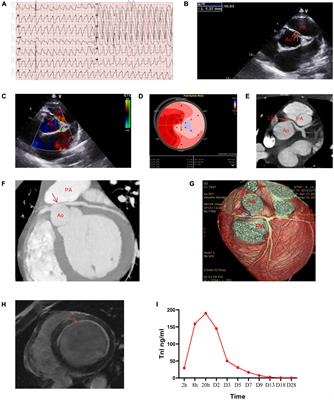 Case Report: Extracorporeal Membrane Oxygenation Followed by Intra-Aortic Balloon Counterpulsation Successfully Treated Cardiac Arrest Caused by Anomalous Origin of a Left Coronary Artery From the Right Coronary Sinus